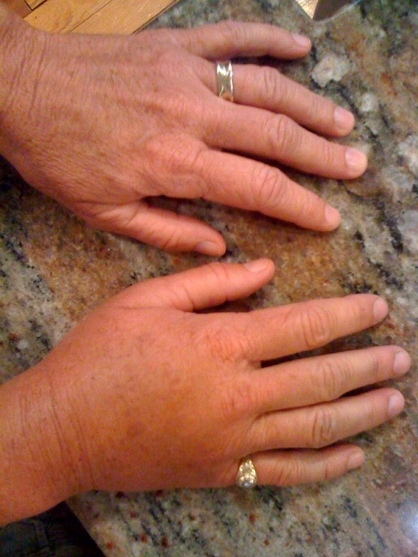 Deb's swollen hand (she doesn't usually wear a ring on her pinky!)